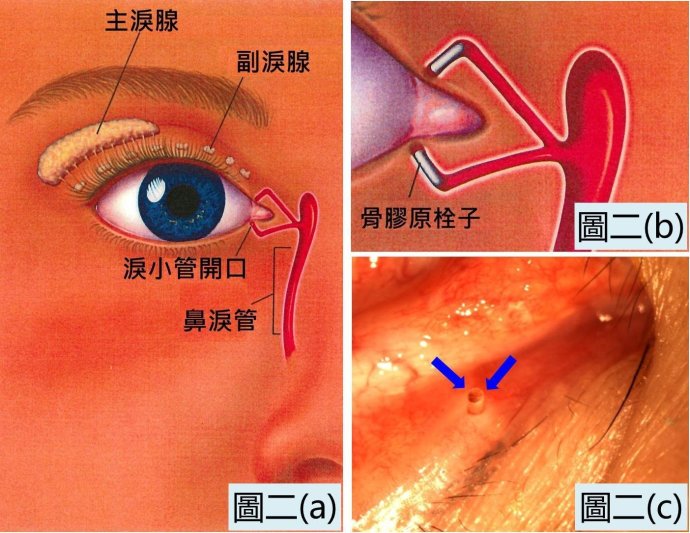 若导致干眼症的基本成因已被处理,但泪水分泌仍不足够,患者可考虑